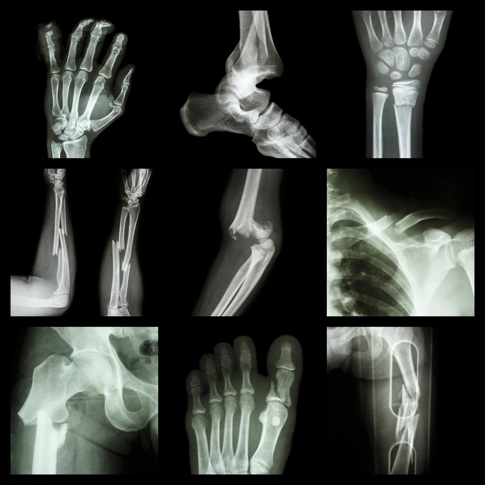 Chicago bicycle accident case with broken bones and fractures handled by a Chicago bicycle accident lawyer specializing in fracture cases.