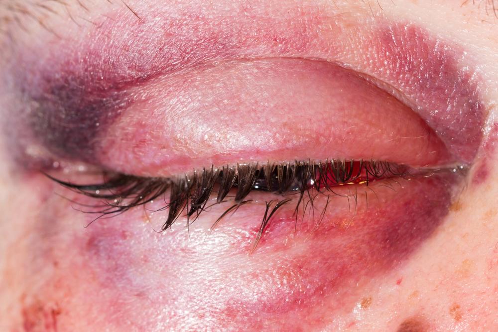Ocular injuries caused by a serious bicycle accident.
