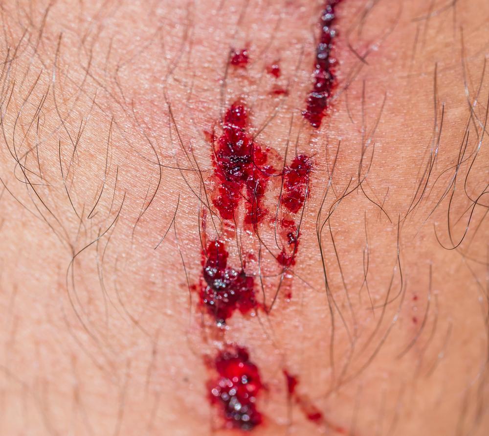 Chicago lawyer representing bicycle accident victims with severe burn injuries.