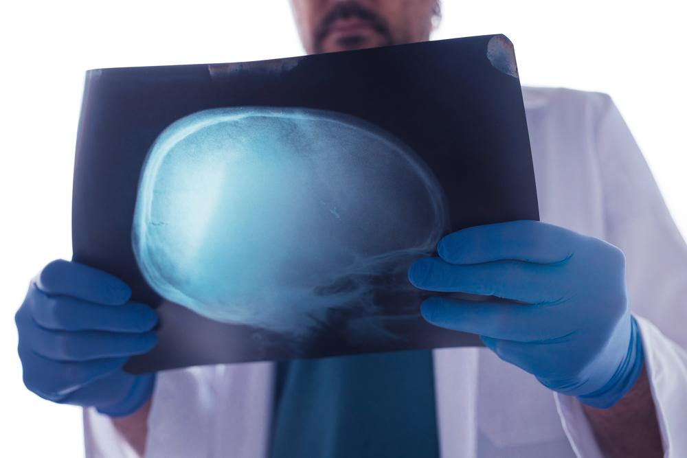 Chicago bicycle accident lawyer offering legal counsel for victims of bicycle head injuries, helping secure compensation through lawsuits for those affected by traumatic brain injuries from bike accidents.