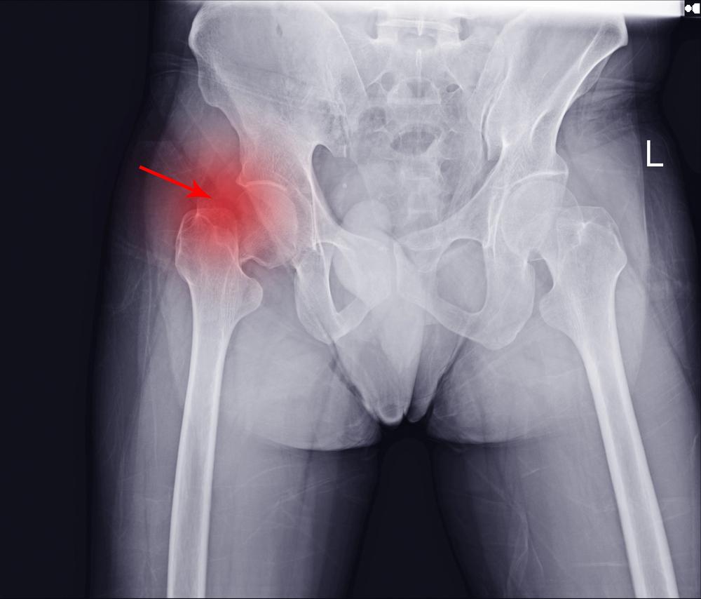 Pelvic fractures caused by a severe bicycle accident.